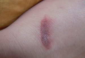 Темные пятна после ран