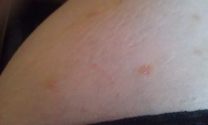 Выпуклые красные пятна на коже, твердые и чешутся