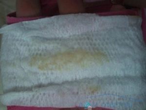 Желтые выделения с кислым запахом