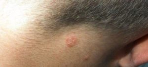 Стригущий Лишай, на его месте маленький прыщ