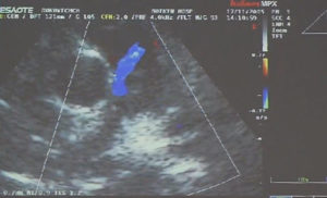 Коронарная фистула диагноз у ребенка