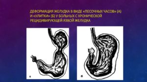 Желудок по типу песочных часов