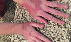 Белизна попала на кожу