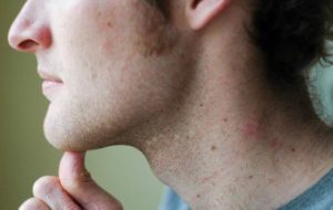 Подбородочный лимфоузел