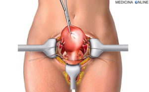 Тяжести после удаления матки