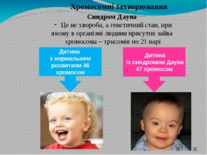 Синдром дауна по кариотипу