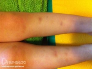 Острый лейкоз, синяки на теле без причины