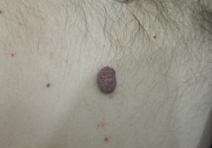 Образования в виде родинок на лобковой части тела