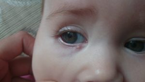 Белый прыщ на веке у ребёнка