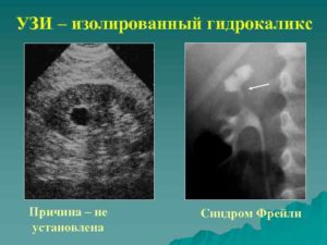 Синдром Фрейли