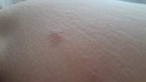 Выпуклые красные пятна на коже, твердые и чешутся