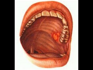 Язвочка на небе