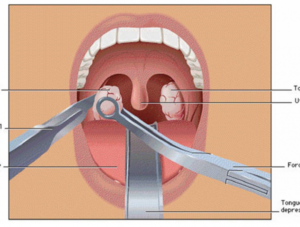 После удаления миндалин