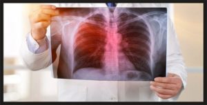 Онкология легких Помогите понять результат 7