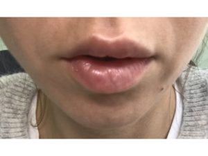 Комки после филлера