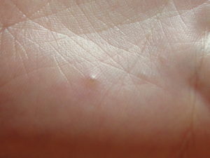 Белый шарик (прыщик) на руке у ребенка