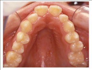 Готическое нёбо