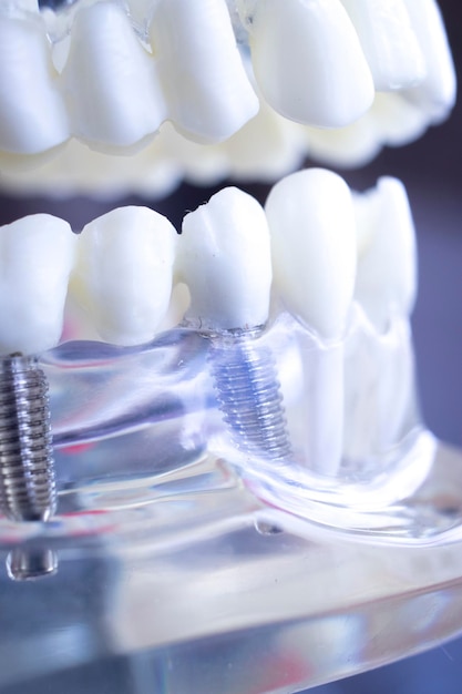 Этапы процедуры имплантации: что ожидать на каждом шаге