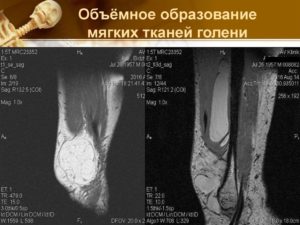 Образование в мягких тканях