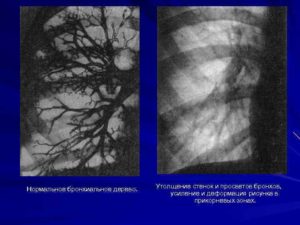 Просветы бронхов умеренно расширены, стенки незначительно уплотнены
