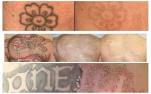 Солярий после удаления татуировки?