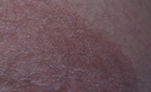 Краснота вокруг половых органов