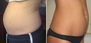 Нет шевелений в 17 недель