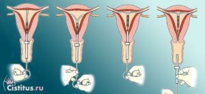 Кровит после удаления спирали