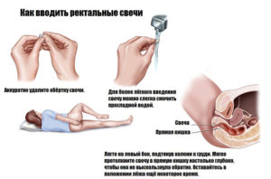 Нужно ли вставлять свечу заново при геморрое после туалета