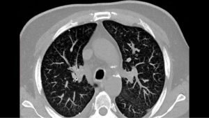 КТ грудной клетки. Астма или нет?
