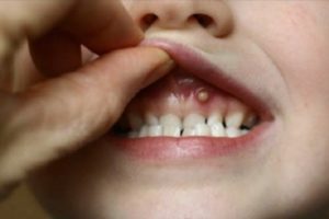 Белые бугорки на десне