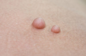 Прыщи возле соска