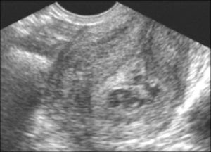 Посла фармаборта по узи остатки хориональной ткани