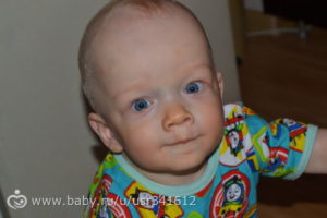 У ребенка пожелтели ладони и нос