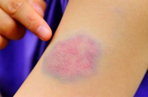 Пятно после синяка