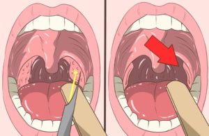 После удаления миндалин