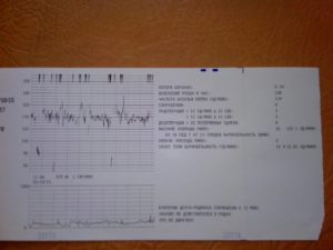 Расшифровка КТГ 40 недель