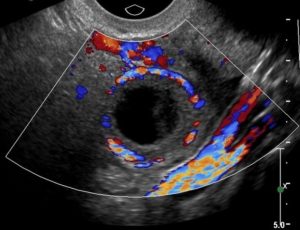 Анэхогенное включение