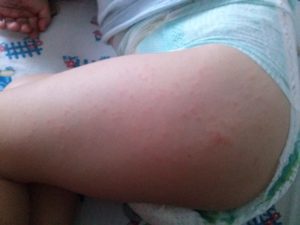 Сыпь на попе и ногах ребенка