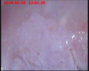 Обнаружили белое пятно на шейке матки