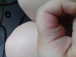 Белый шарик (прыщик) на руке у ребенка