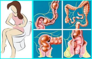 Газы мелкими дозами, тонкий кап, неполное опорожнение