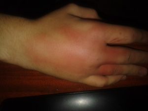 Помогите! Выбил казанок на правой руке мизинца