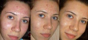 Чистка лица и пилинг при ГВ