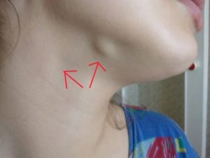 Увеличение лимфатических узлов по челюстью