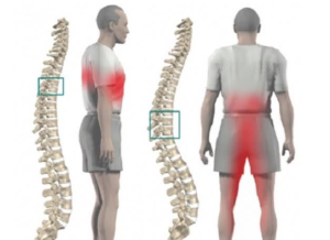 Остеохондроз шоп и поп