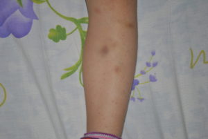 Острый лейкоз, синяки на теле без причины