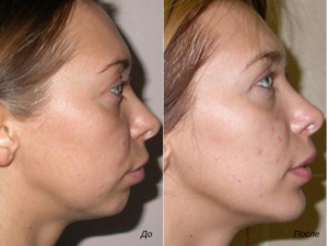 Осложнения после коррекции подбородка филлером