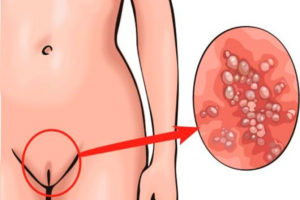 Зуд в области клитора
