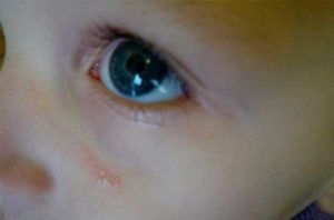 Белый прыщ на веке у ребёнка